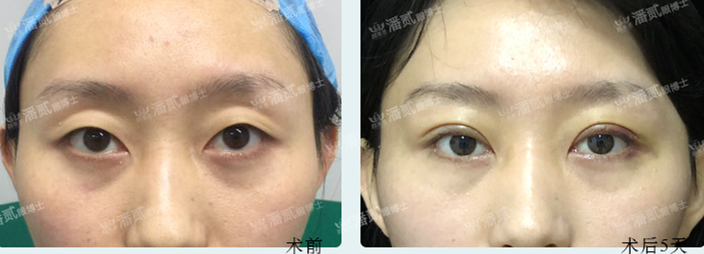 但可以适当增加上睑饱满度,以缓解眼窝凹陷的症状,除了自体脂肪填充外