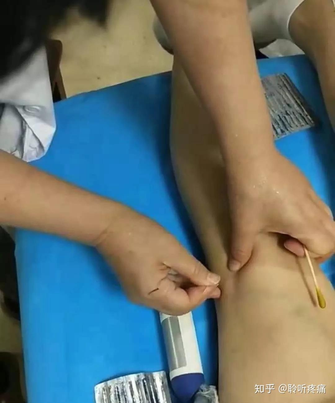 年终钜惠肌筋膜疼痛触发点干针技术研修班开课啦