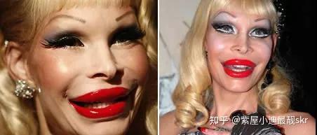 慎入 最惨烈的整形失败案例 下一个就是你 知乎 慎入 最惨烈的整形失败案例 下一个就是你 知乎