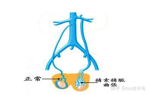 精索静脉曲张远比你想的要可怕!发现后应该怎么办呢? - 知乎
