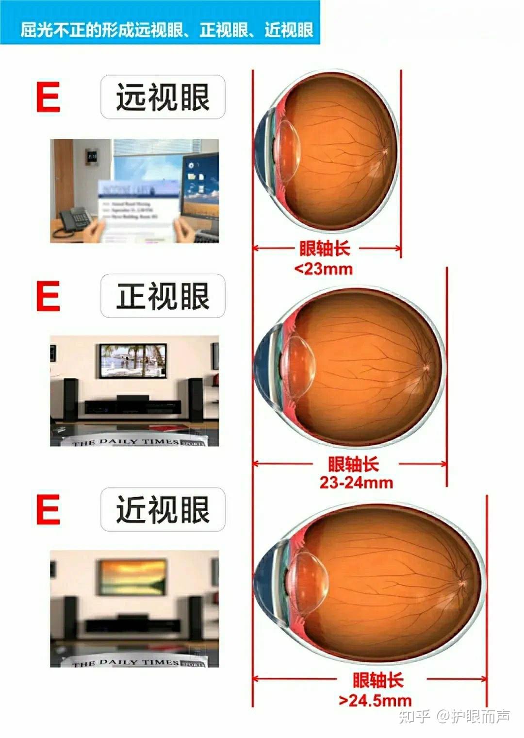 正常眼位图图片