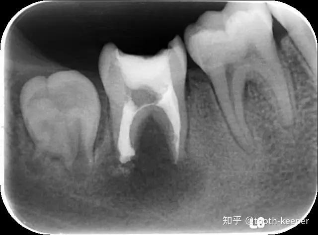 右下第二磨牙慢性根尖炎一例