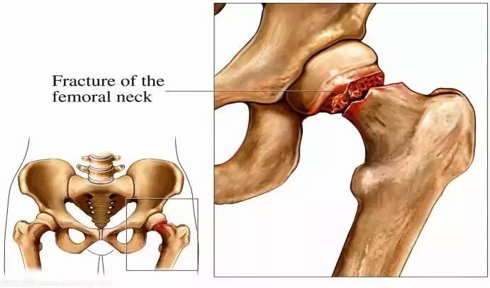 股骨颈图片 解剖图图片