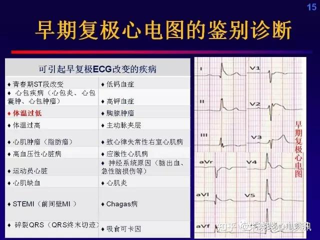 j波綜合徵概念與認知的更新國際專家上海共識