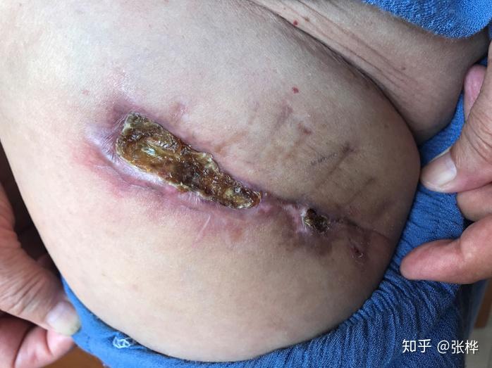 医理求真——右髋部血肿清除术后2月伤口不愈合 - 知乎