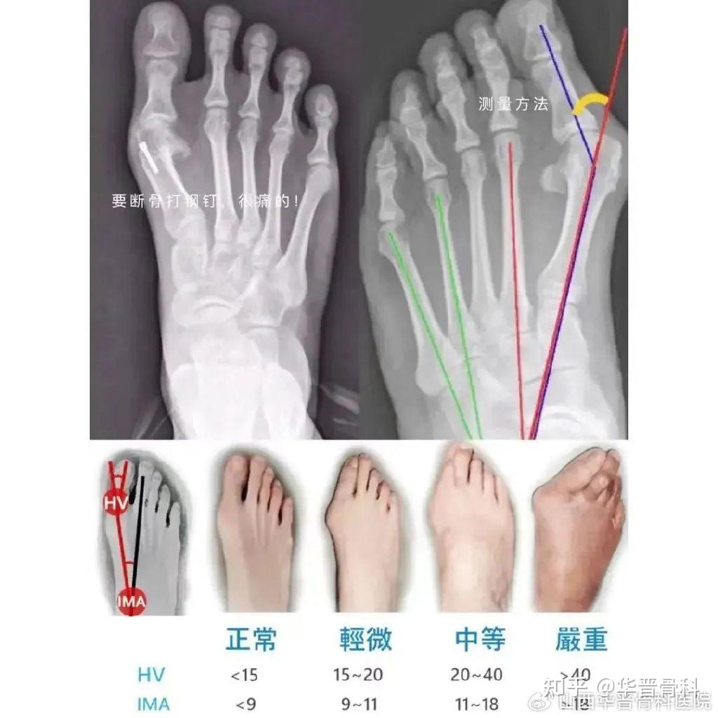 【健康科普】拇外翻？经常脚疼的人该注意了 - 知乎