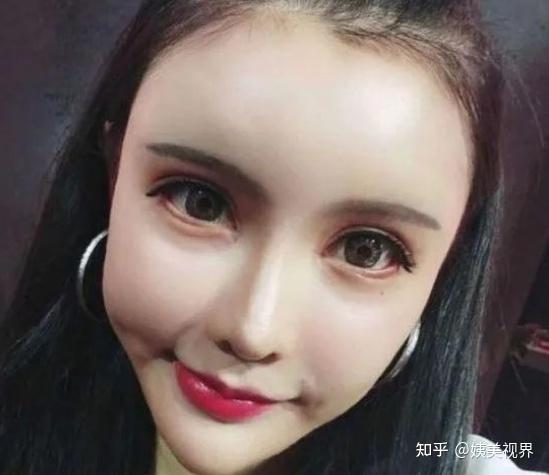 一,面部设计不到位:过度饱满,不该填的位置瞎填!