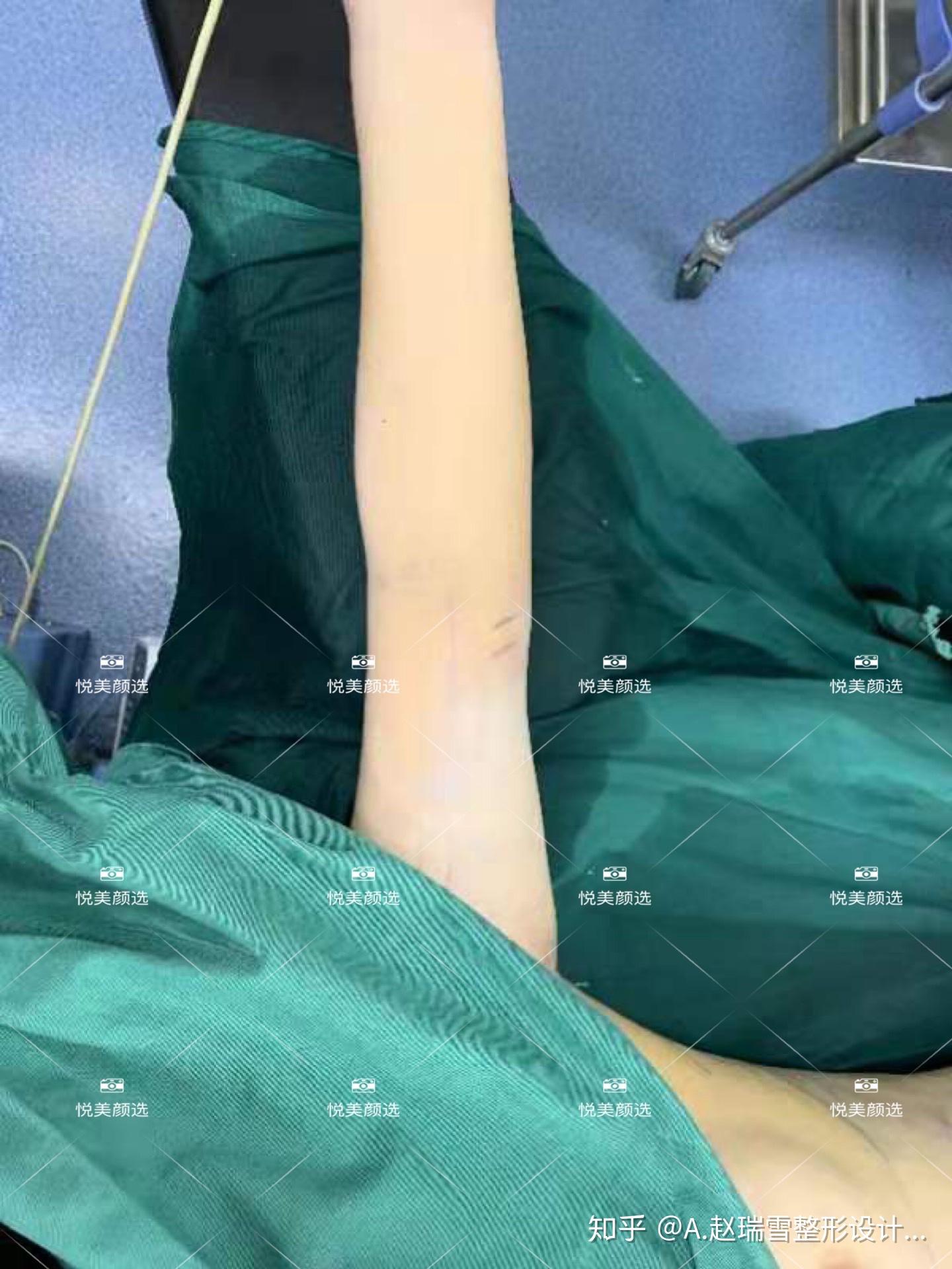 有人手臂蝴蝶袖吸脂过吗?效果如何?