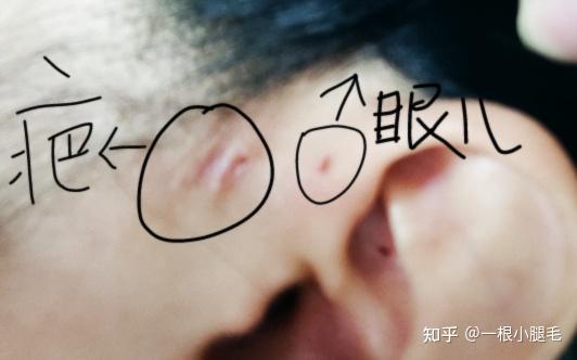 左边是引流手术的疤,右边是耳瘘管的小眼.