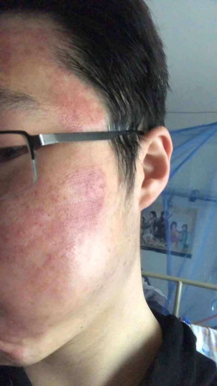 点阵激光plasma记录