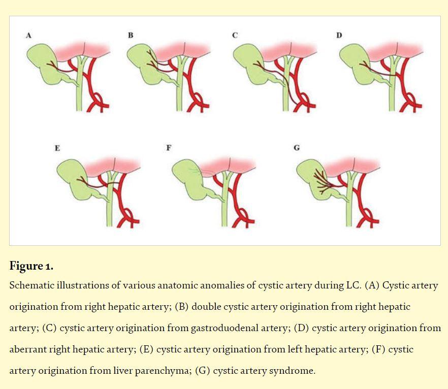 胆囊供血动脉解剖图片图片
