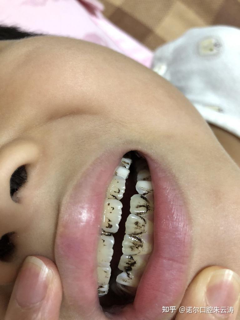对于小孩子来说,牙齿也要去做定期的清洁,如果牙齿上已经产生色素了