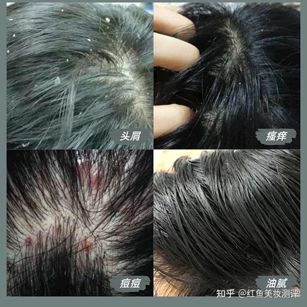 什么洗发水用了头皮不痒?? - 知乎