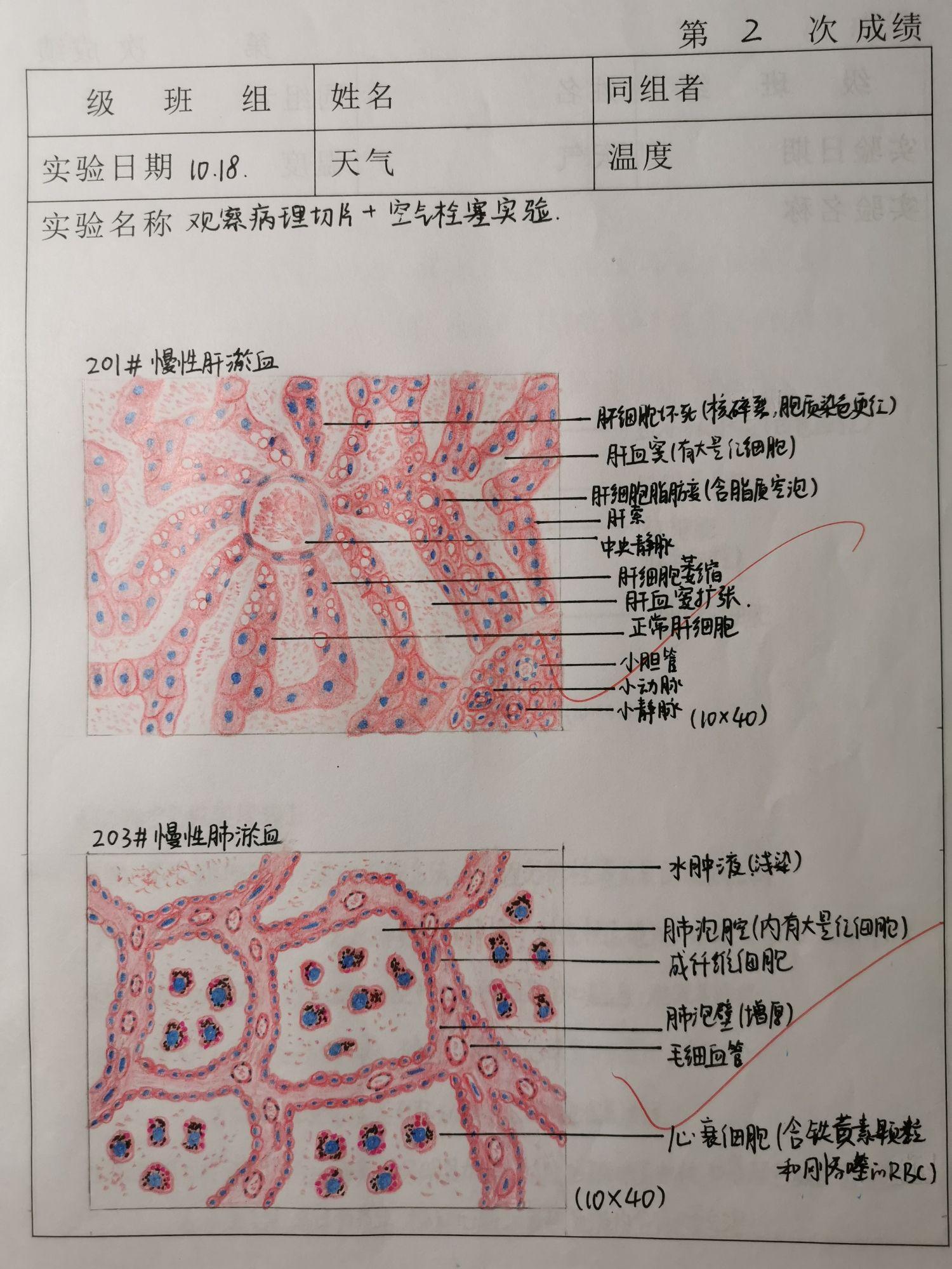 肺淤血手绘图作业图片