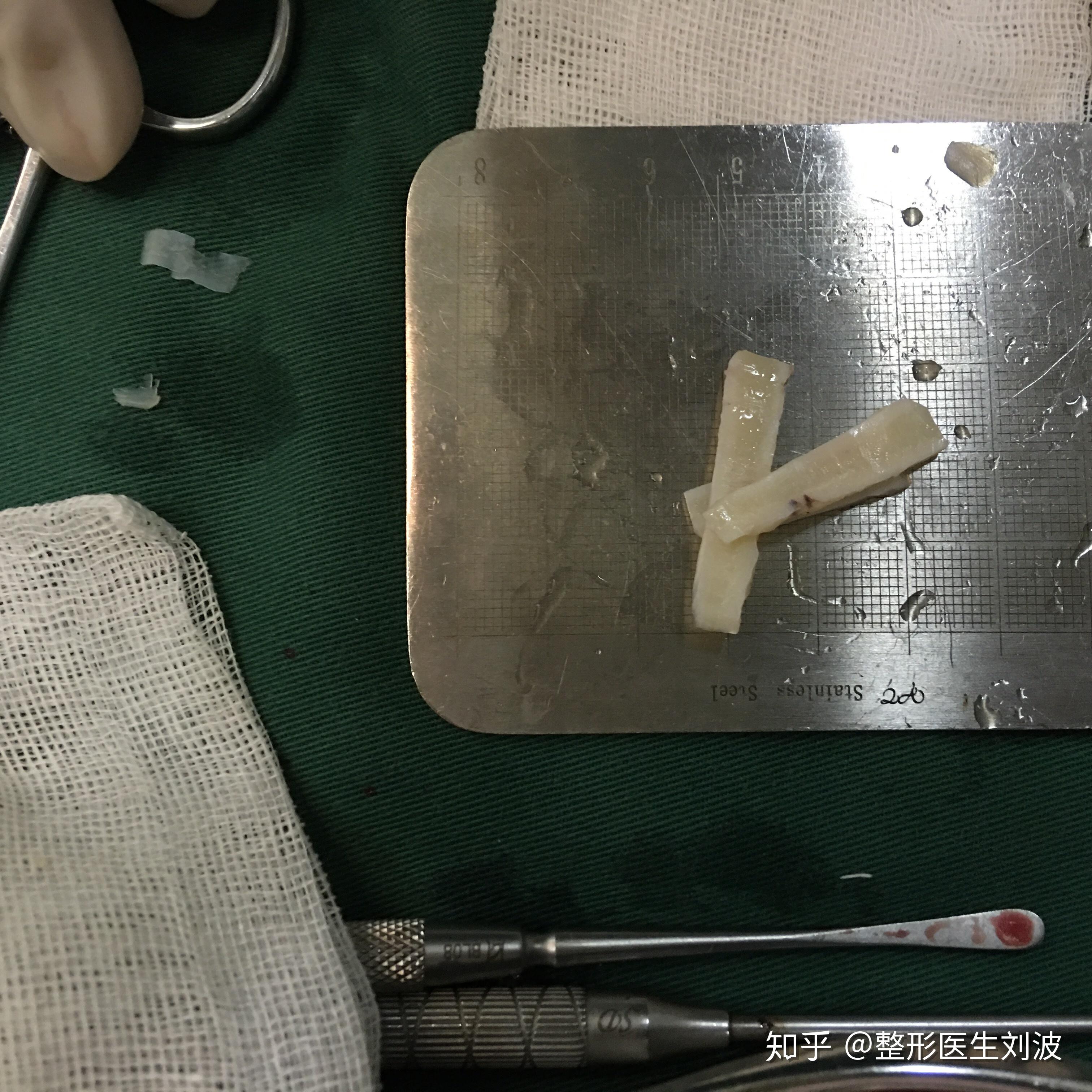 肋软骨隆鼻是怎么搭支架的