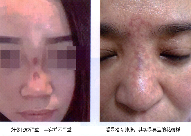 微整或将失明,注射美容血管栓塞并发症的成因,辨别,治疗详解