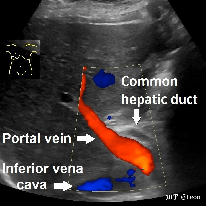 胆总管 Common bile duct - 知乎