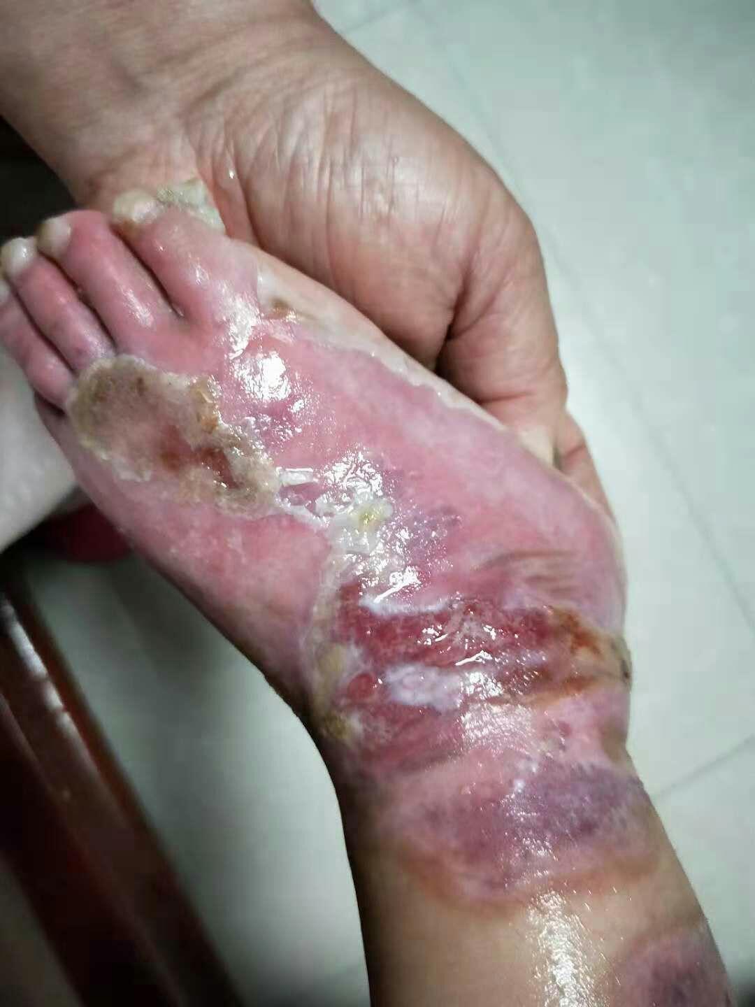 辽宁两岁小孩烫伤10在医院治疗26天花费2万多元未治好经介绍由我接手