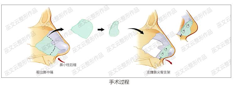 鼻小柱延长是怎么做的图片