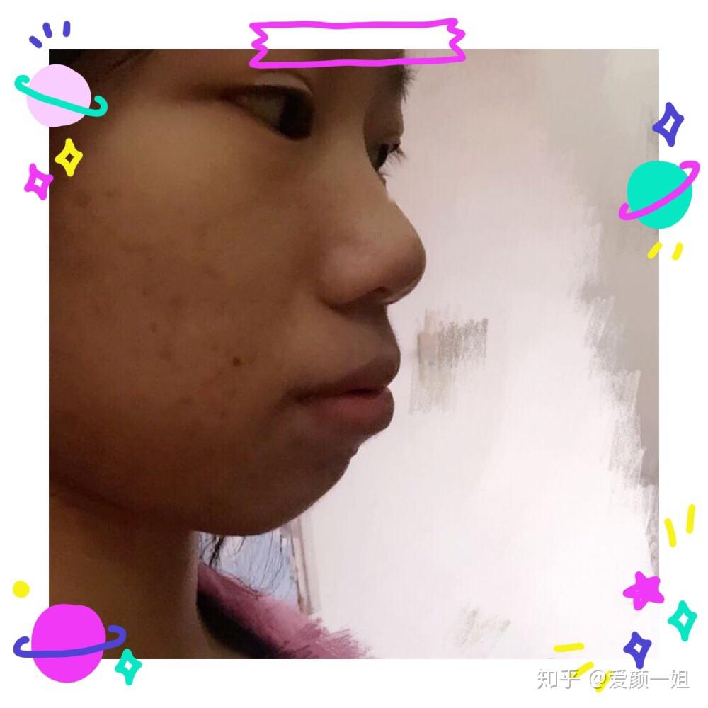 全国正颌地包天凸嘴医生功课来了