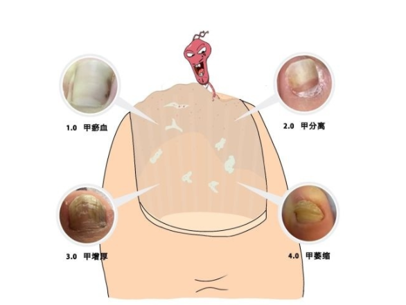 甲分离和灰指甲的区别图片