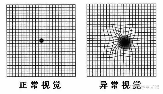 白内障自测图年轻人图片