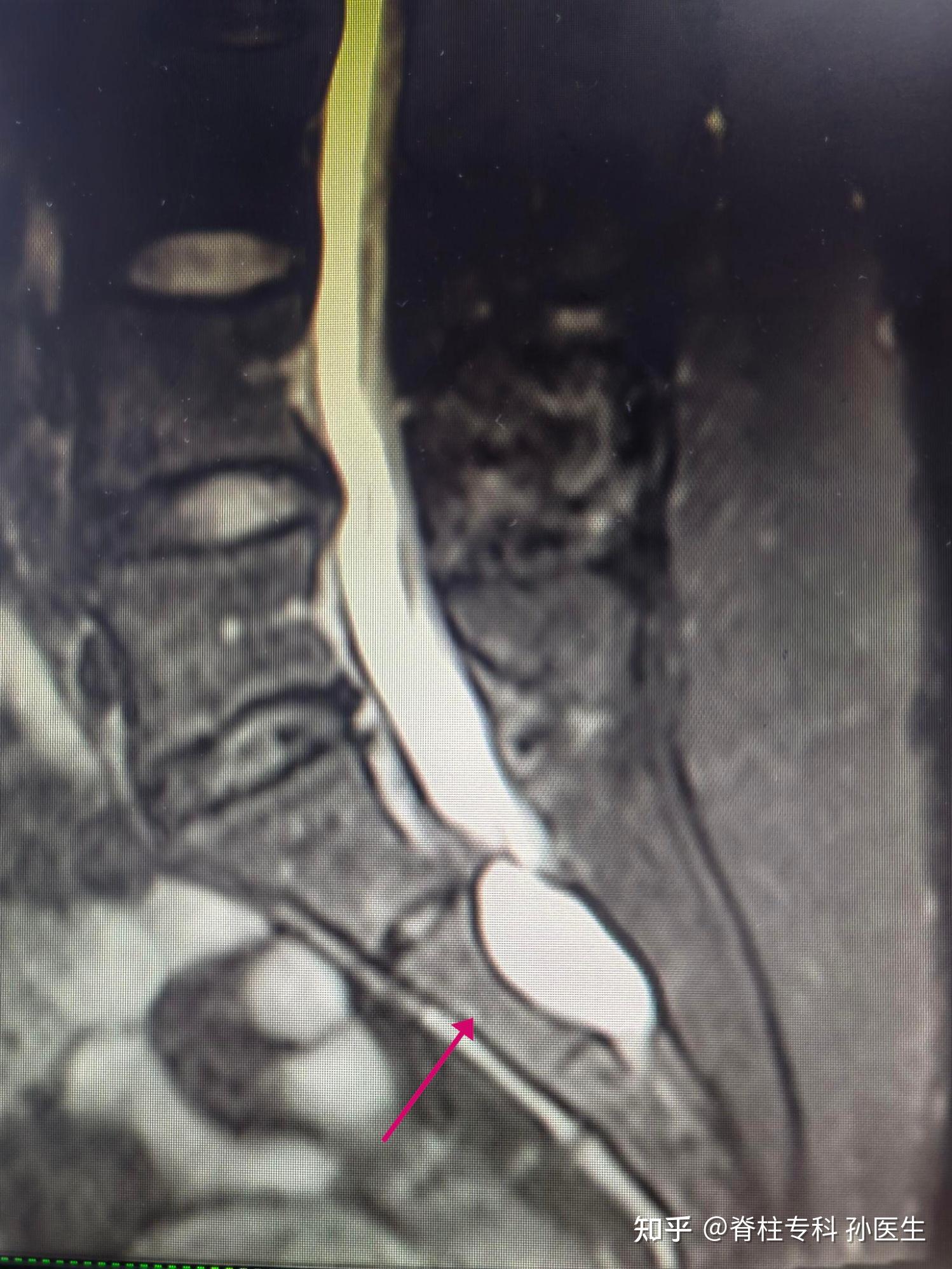 骶管囊肿手术过程图片图片
