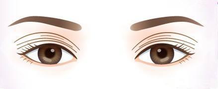 什么是多重睑呢 为什么是好几层呢 知乎