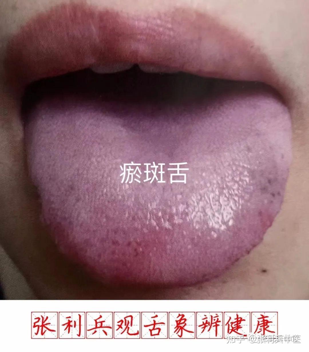 张利兵:“观舌象辨健康”第13讲--舌质辨证诊病之瘀斑舌和瘀点舌 - 知乎