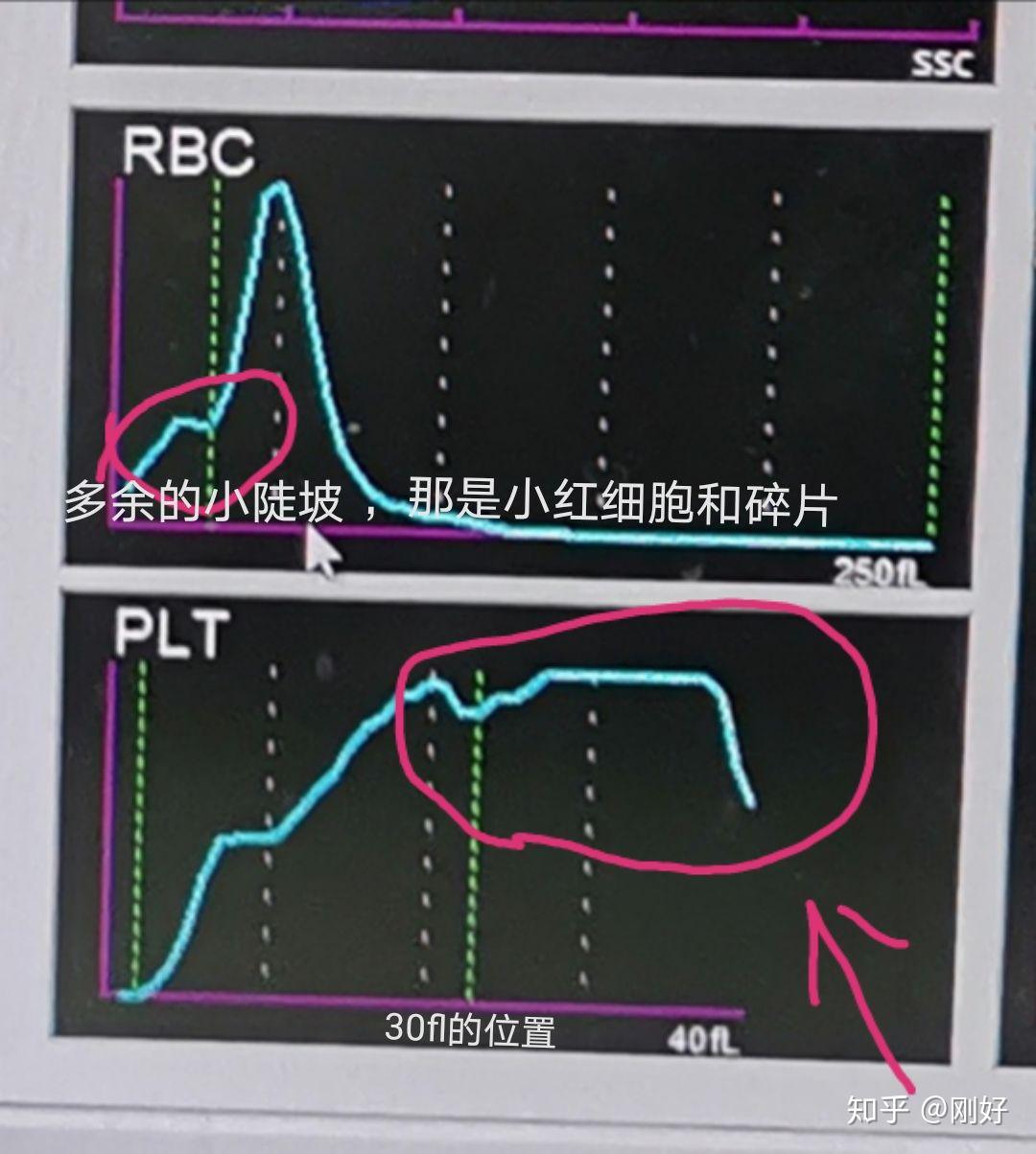 正常血小板直方图图片