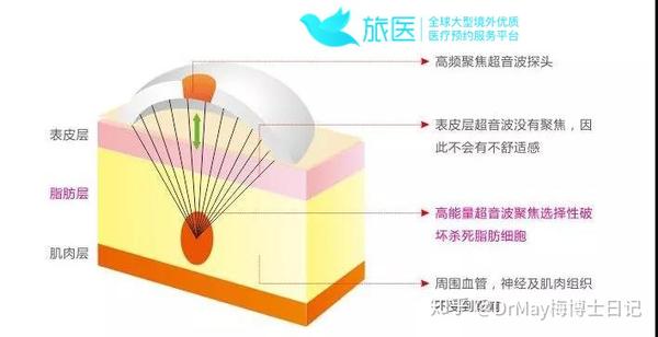 优立塑 让你躺着也能轻松瘦下去 知乎