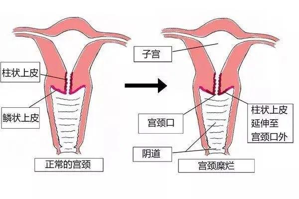 子宫颈在哪里示意图图片