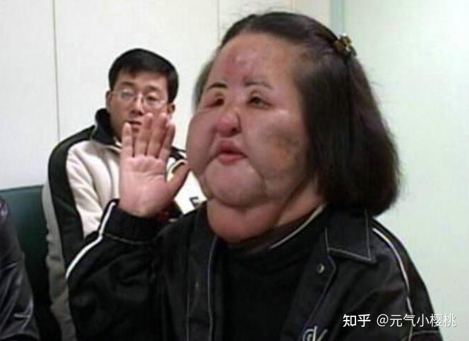 六例全球整容案例,巴西狗头人的奇葩改造手术 - 知乎