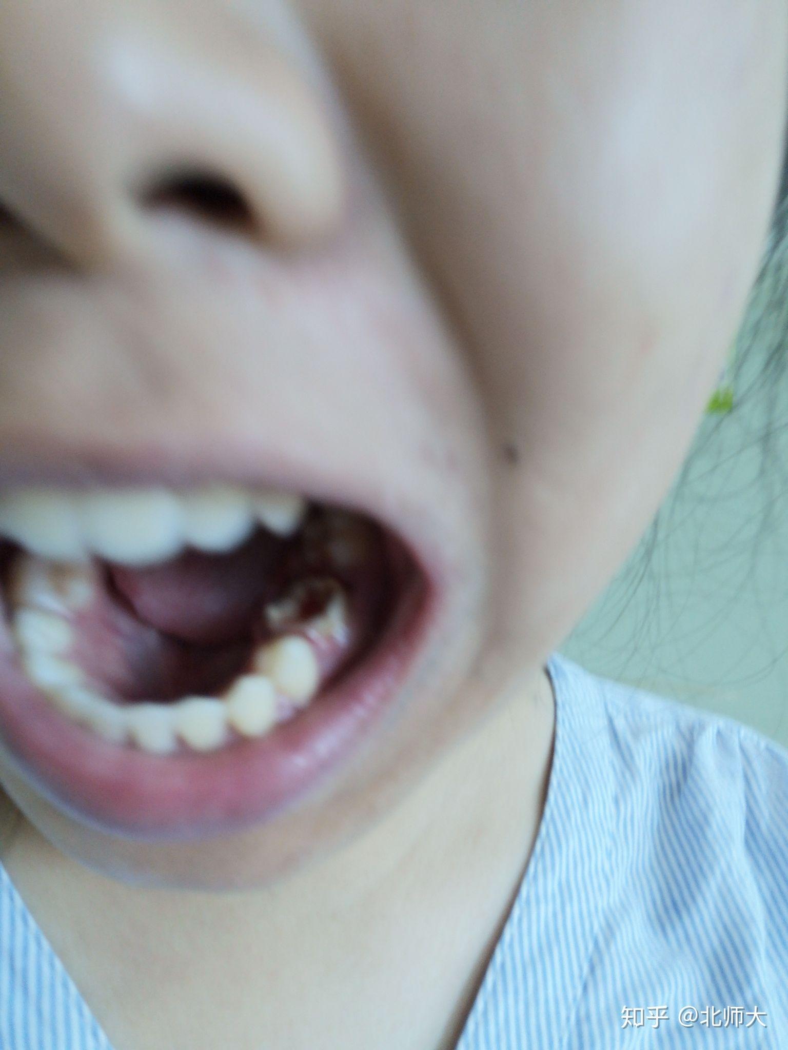 三年前做了氧化锆烤瓷牙现在牙龈一直红肿怎么办_百度知道