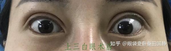 上三白眼长什么样？为何会有上三白眼情况的发生？ - 知乎