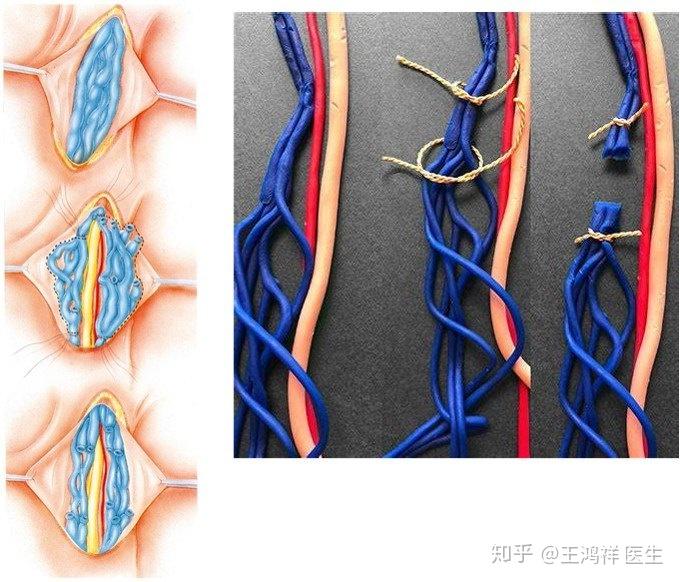 阴囊水肿和睾丸鞘膜积液:此并发症与术中损