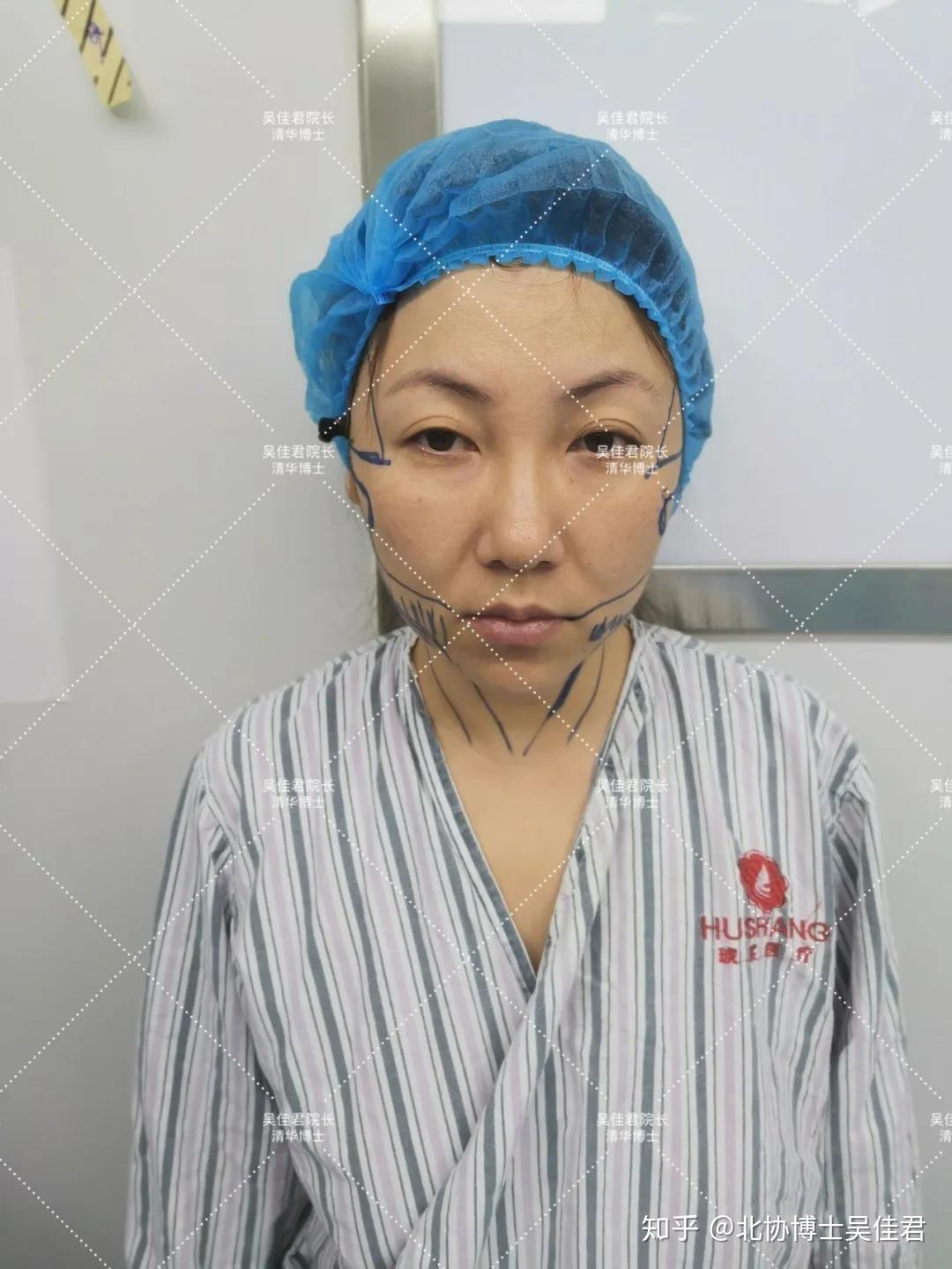 5小时10分“全脸拉皮”，43岁女士大拉皮手术过程，真实细节分享 - 知乎
