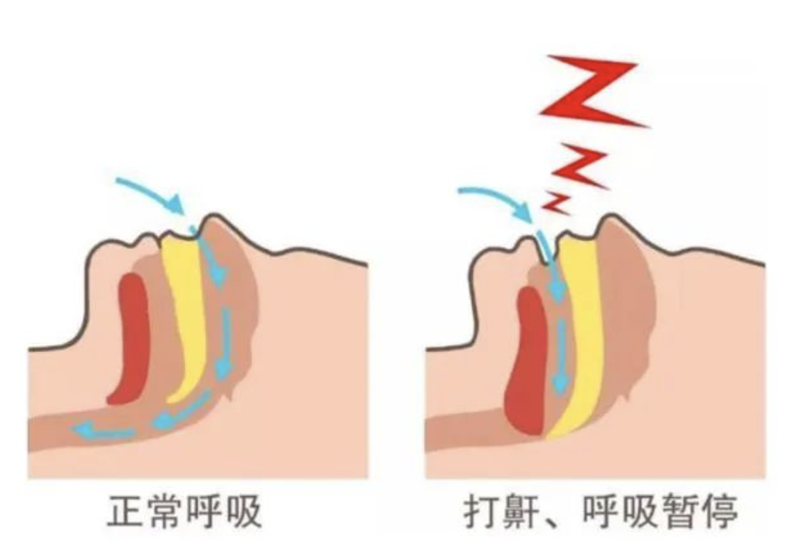 打鼾结构图片