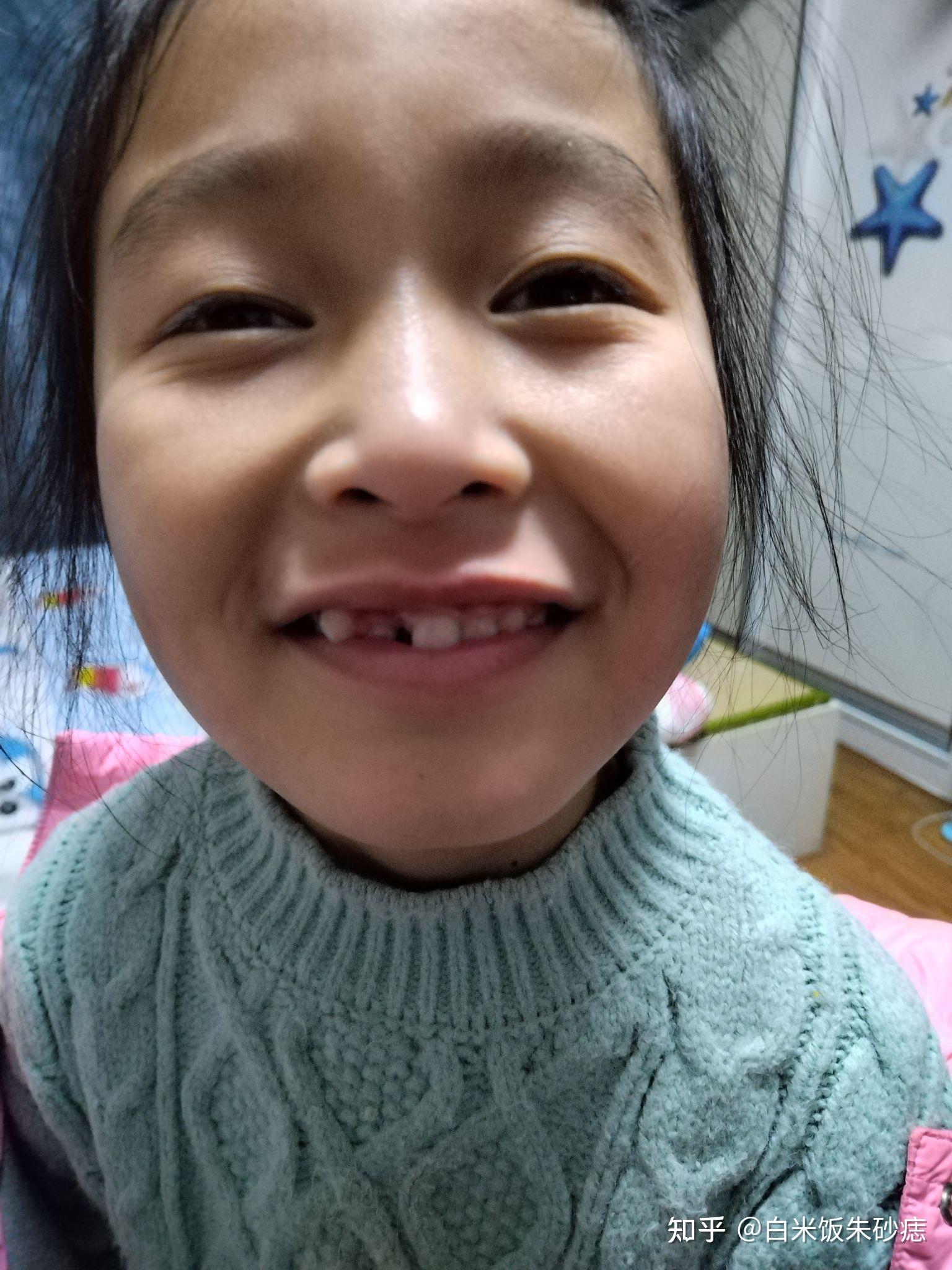 儿童上颌前牙区埋伏多生牙的处理思路 - 知乎