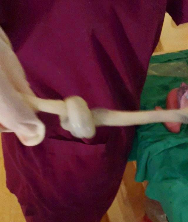 女星谢依霖生二胎晒出脐带打结照片真结或假结最怕被误诊