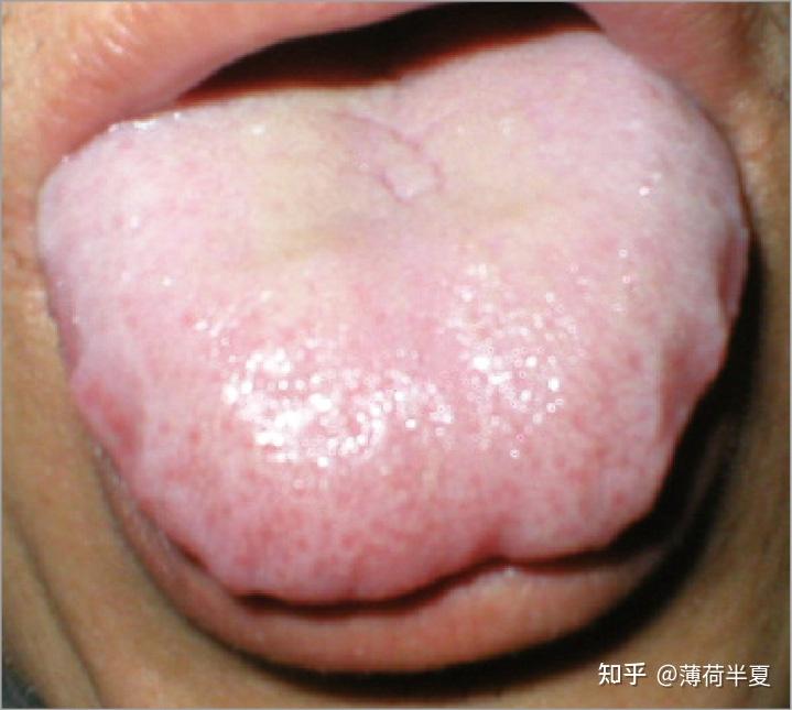 齿痕舌胖大舌(1)舌象特征 舌体比正常的大而厚,伸舌满口,称为胖大舌