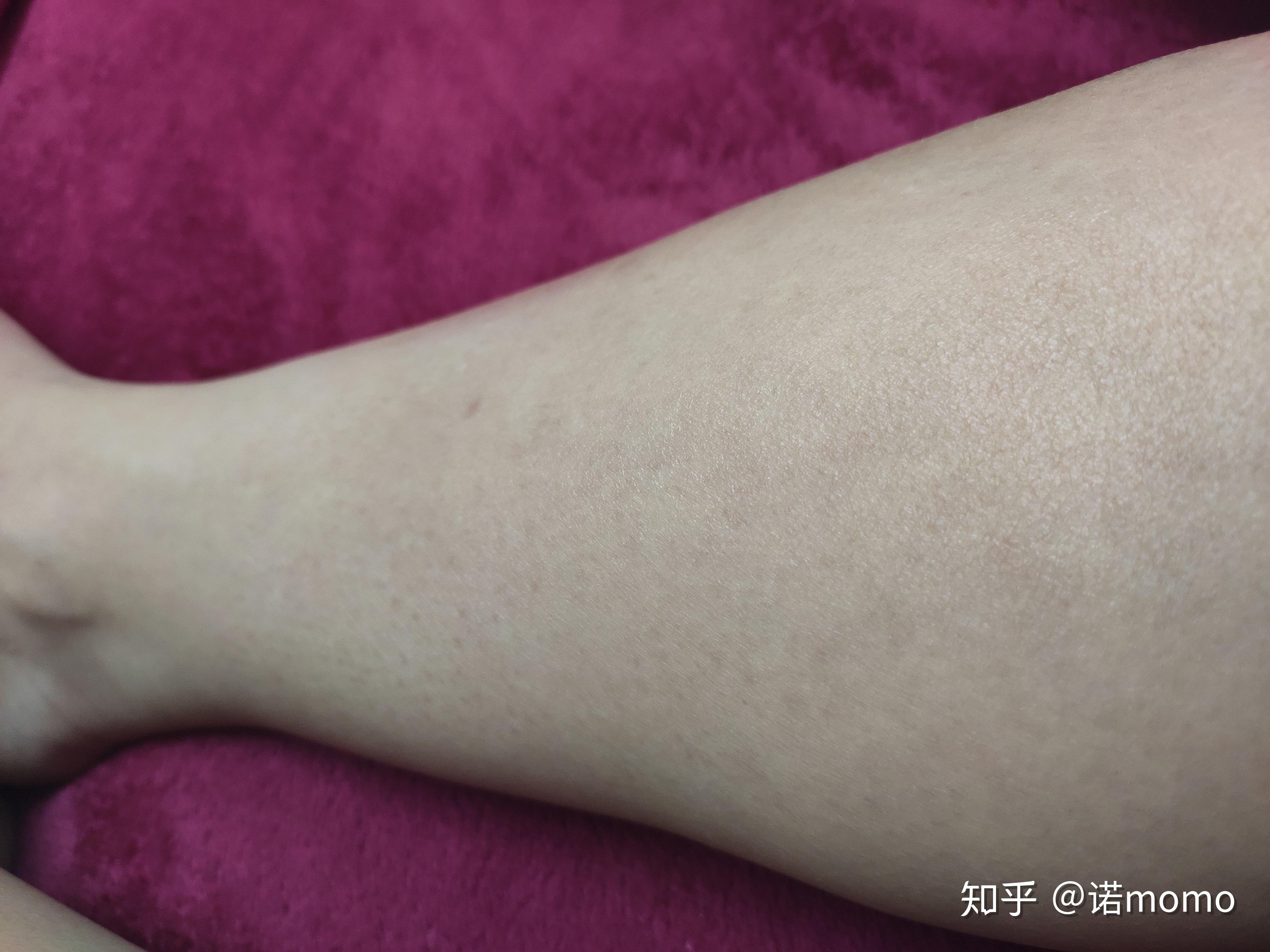 激光脱毛6年后后悔了『激光脱毛6年后后悔了肤色不白能用激光脱毛吗』