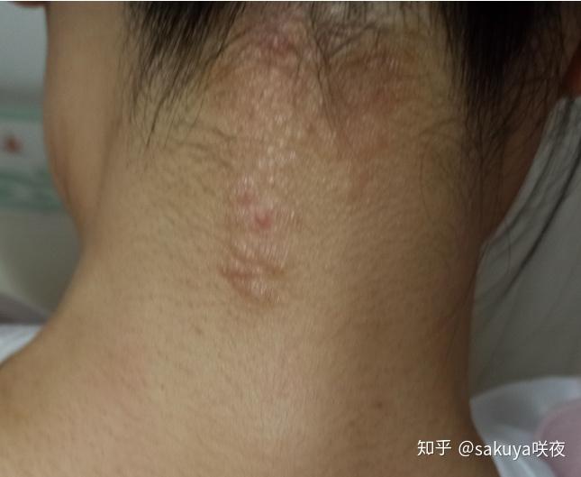 四年的神经性皮炎,吃涂一周药就好了 - 知乎
