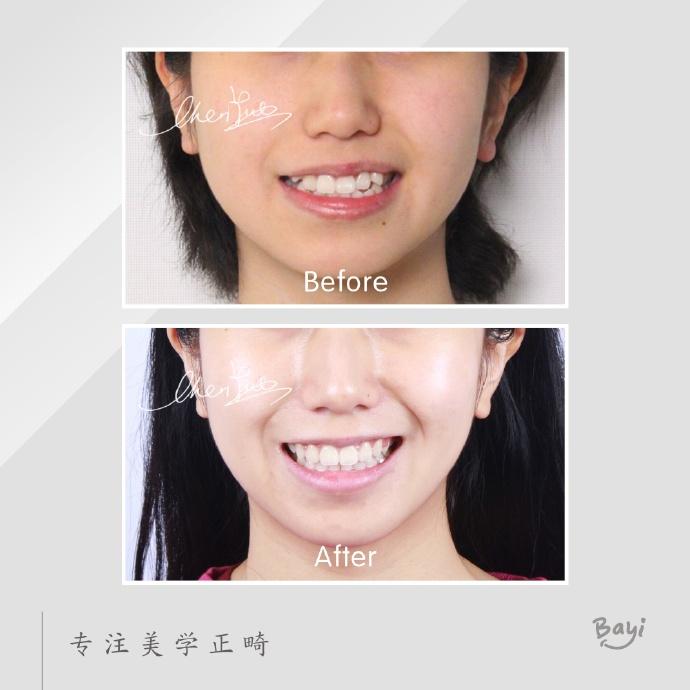 矫正前后面部对比图