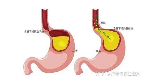 如何诊断是反流性食管炎？中医分型教你辨证论治！ - 知乎