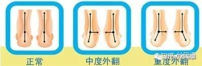 足外翻的影响和调整方法 资料整理4 知乎