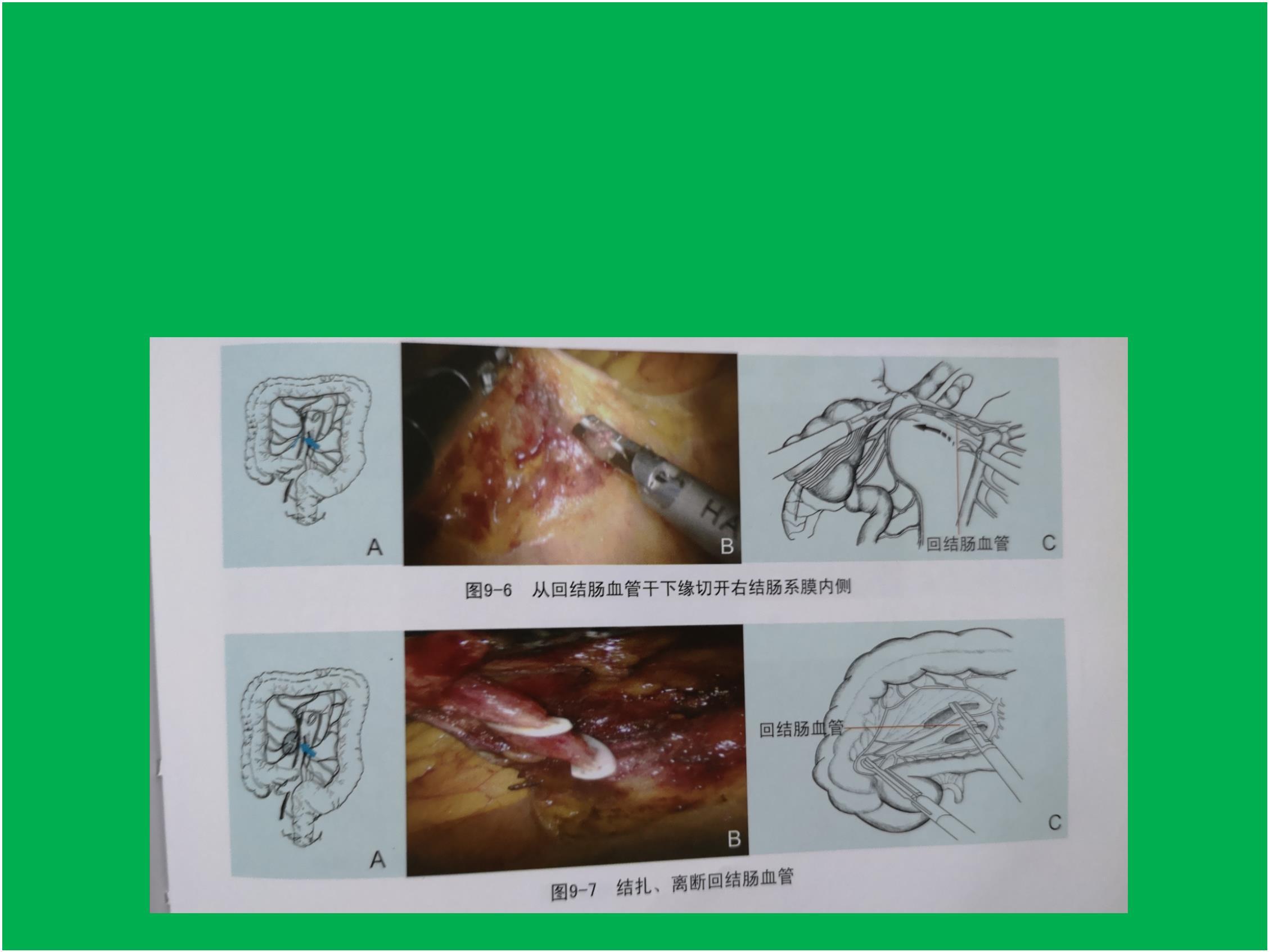 左半结肠癌手术步骤图图片