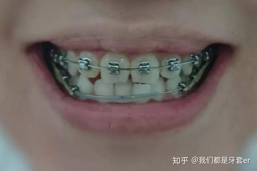 案例分享 | 地包天,前牙对刃颌,没拔牙,只做了片切,戴牙套后从圆脸