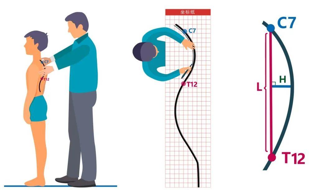 【体态评估】儿童青少年的身体姿态测试与评估规范 - 知乎