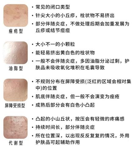 怎么去闭口?脸上都是闭口和粉刺怎么办 - 知乎